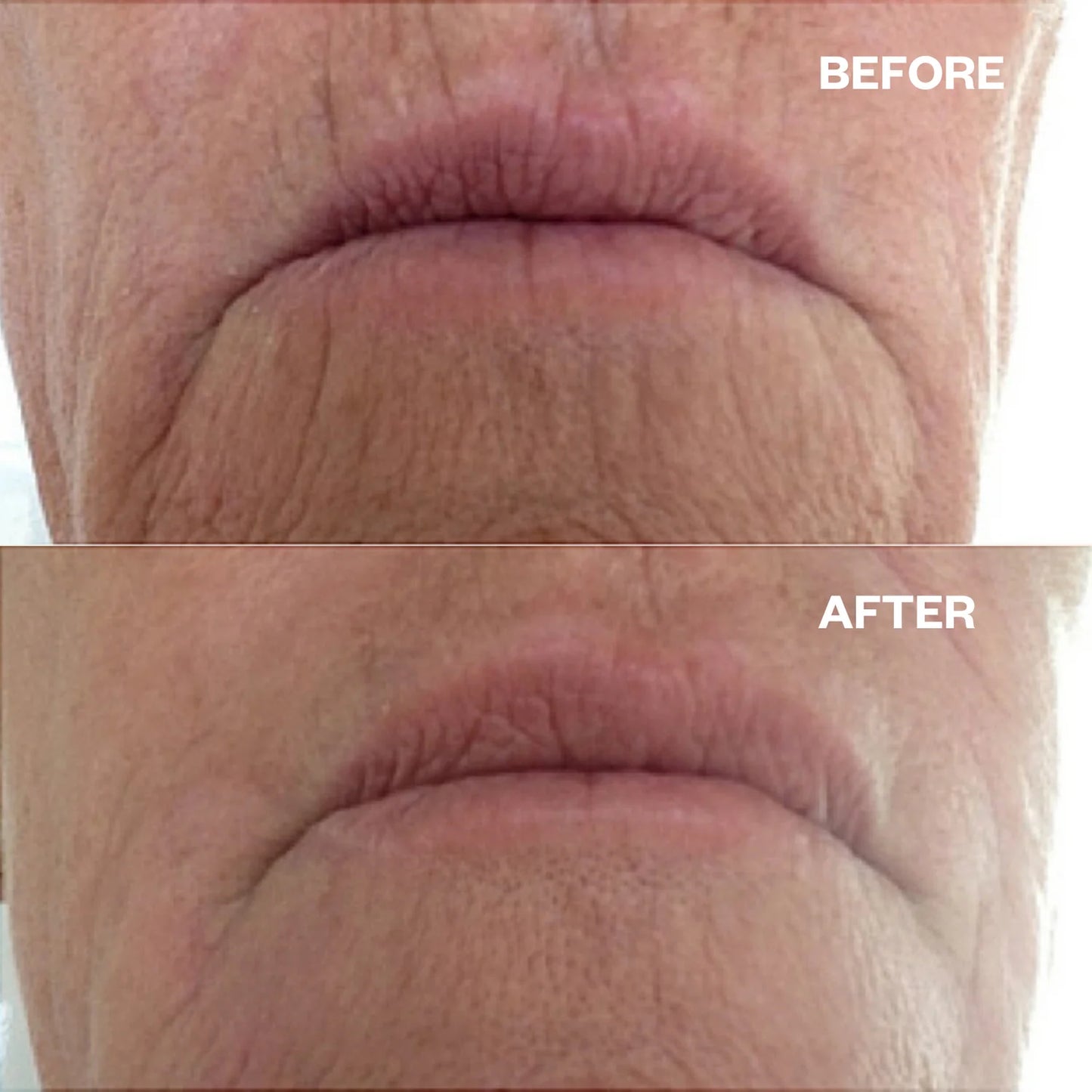 Wrinkles Shminkles Wrinkles Schminkles Mouth & Lip Wrinkle Patches